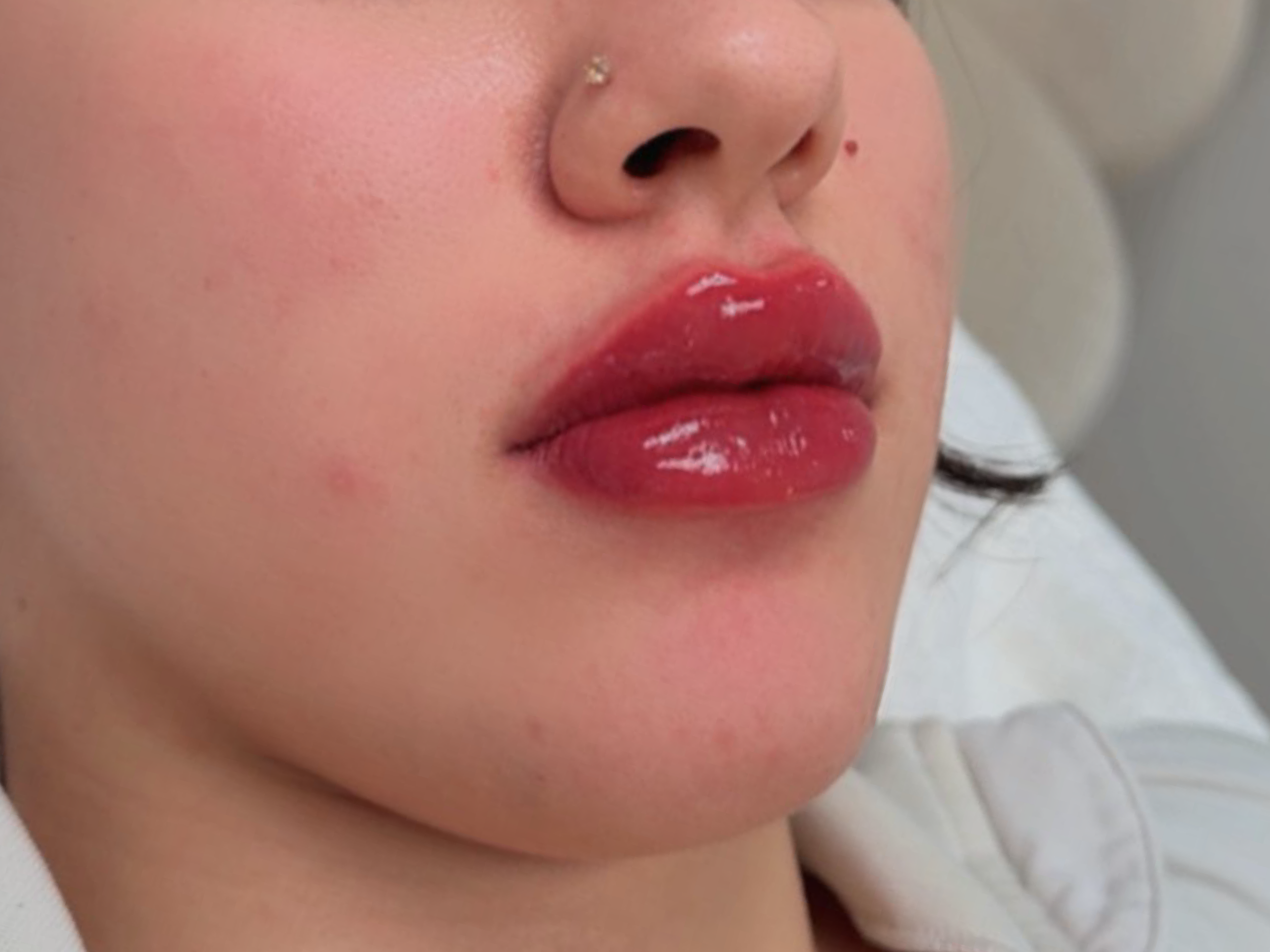 Lip filler before after-02